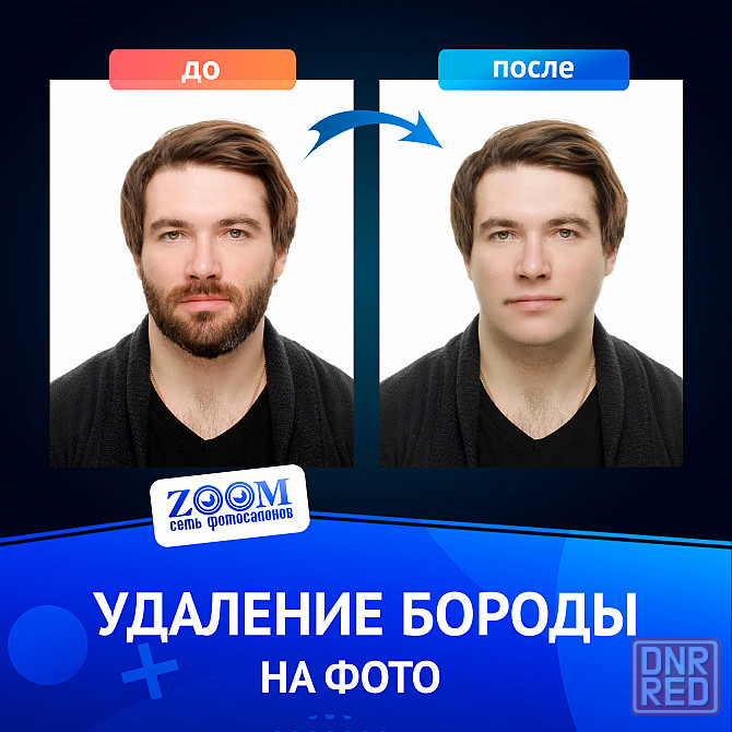 Удаление бороды Донецк - изображение 2