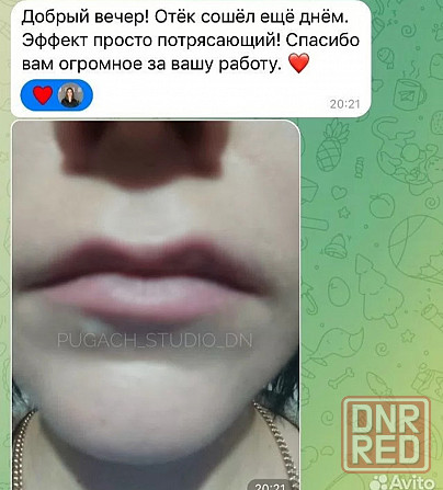 Лазерное удаление Донецк Донецк - изображение 4