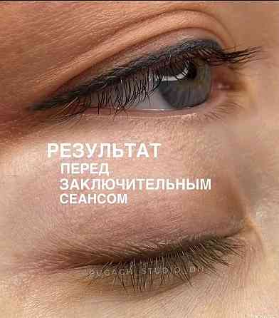 Студия лазерного удаления Донецк Донецк