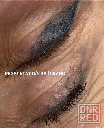Студия лазерного удаления Донецк Донецк - изображение 2