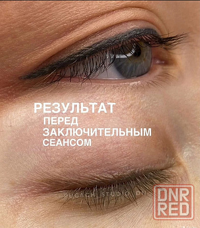 Студия лазерного удаления Донецк Донецк - изображение 1
