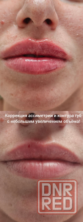 Коррекция фигуры | Косметология | Лазерная эпиляция | Массаж Донецк - изображение 5