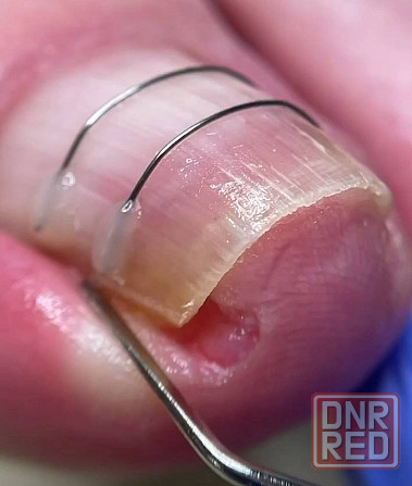 Подолог - есть выезд на дом Донецк - изображение 1