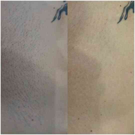 Лазерная эпиляция в Шахтерске Шахтерск