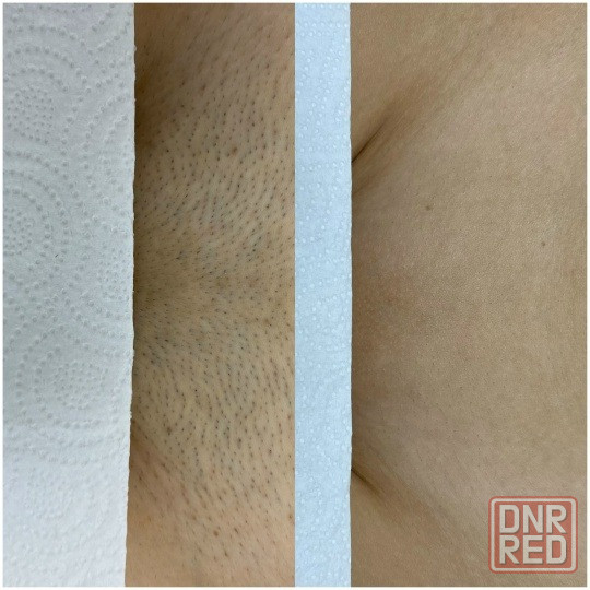 Лазерная эпиляция в Шахтерске Шахтерск - изображение 2