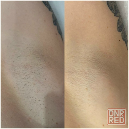 Лазерная эпиляция в Шахтерске Шахтерск - изображение 3