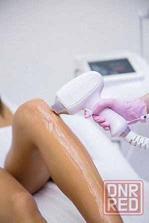 Лазерная эпиляция Мариуполь - изображение 1