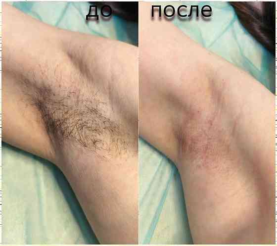 Услуга мастера по депиляции воском Макеевка