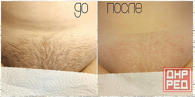 Услуга мастера по депиляции воском Макеевка - изображение 5