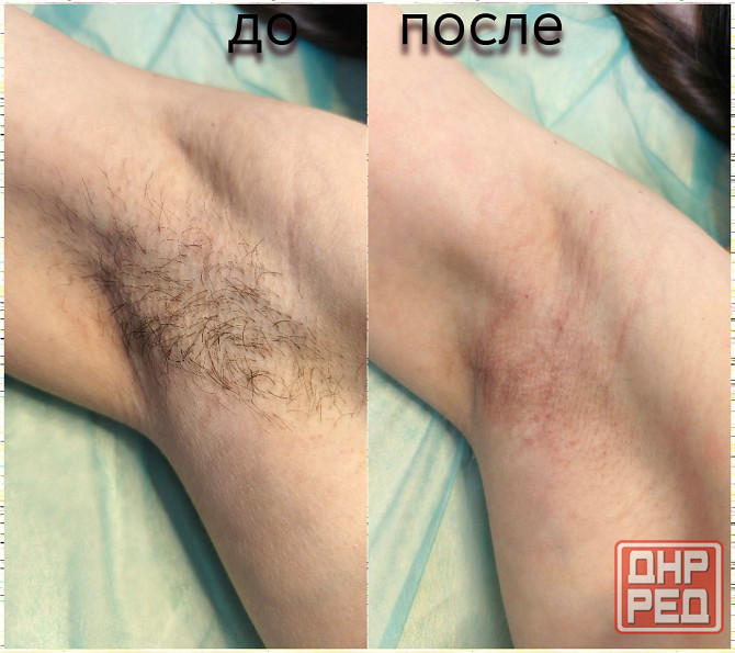 Услуга мастера по депиляции воском Макеевка - изображение 2