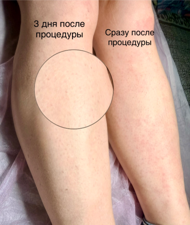 Электроэпиляция Донецк
