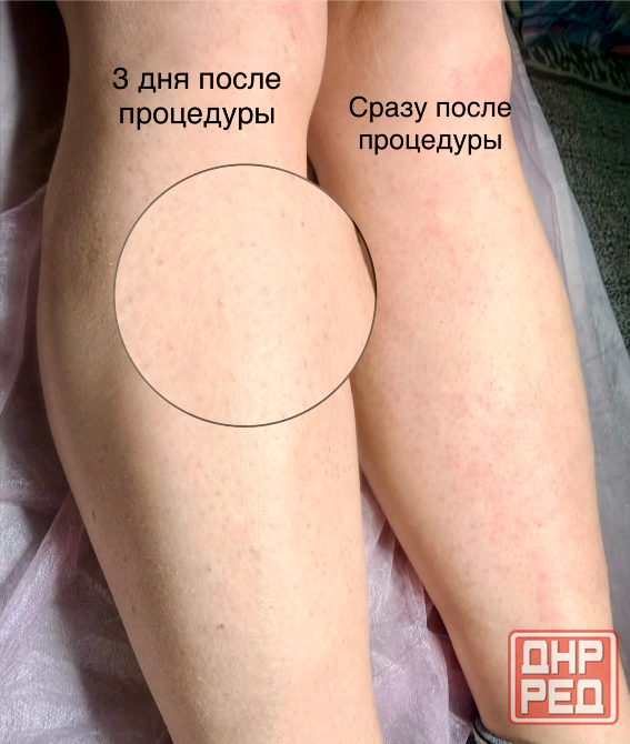 Электроэпиляция Донецк - изображение 2