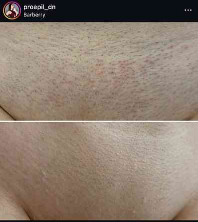Лазерная эпиляция Донецк
