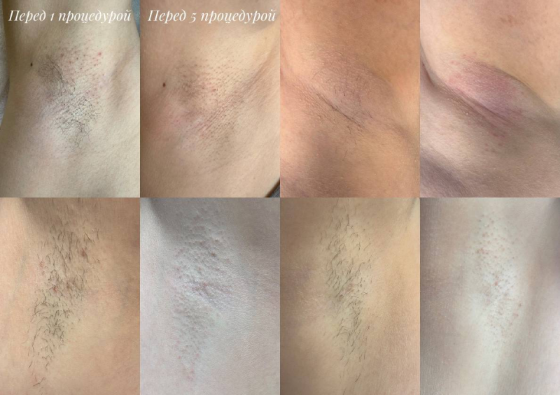 Электроэпиляция Донецк