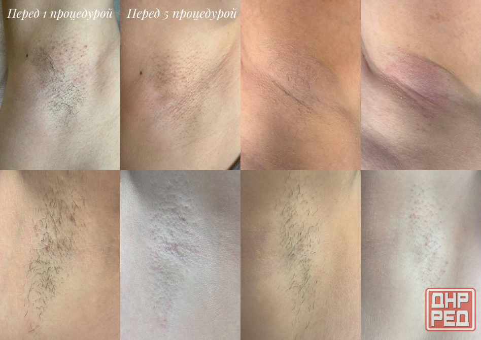 Электроэпиляция Донецк - изображение 2