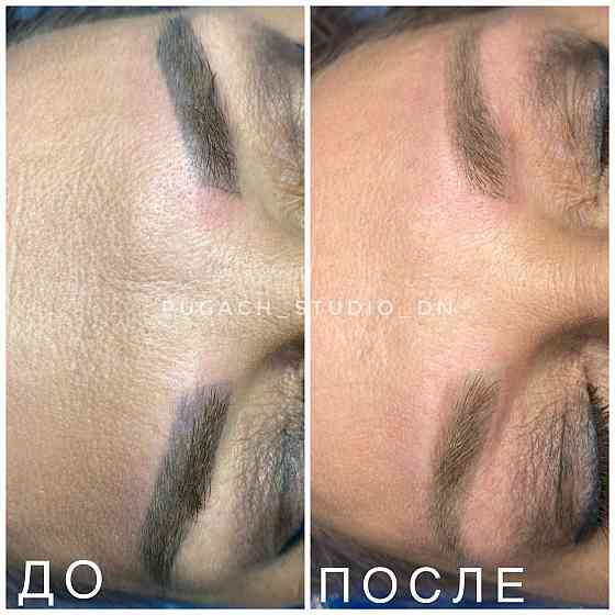Удаление тату, татуировок, перманентного макияжа (татуажа) лазером Донецк