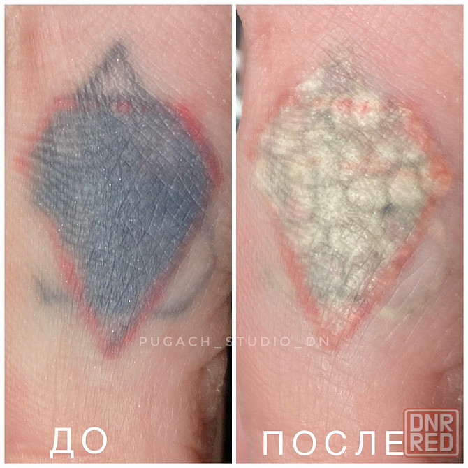 Удаление тату, татуировок, перманентного макияжа (татуажа) лазером Донецк - изображение 2