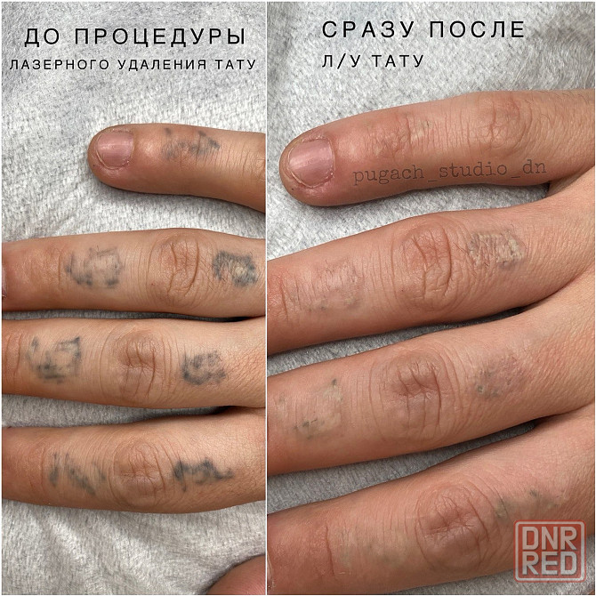 Удаление тату, татуировок, перманентного макияжа (татуажа) лазером Донецк - изображение 1