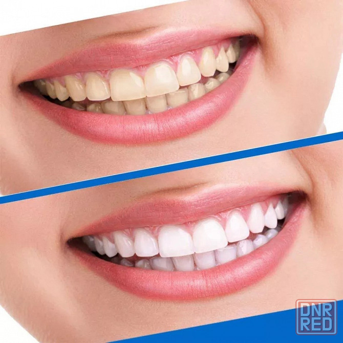 Отбеливающие полоски для зубов | 5D WHITE TEETH | Отбеливание зубов Донецк - изображение 4