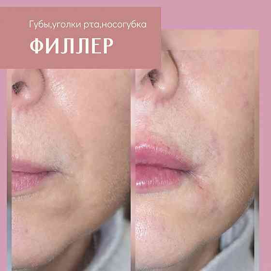 Косметолог Запорожье. Увеличение губ, мезотерапия, татуаж Запорожье