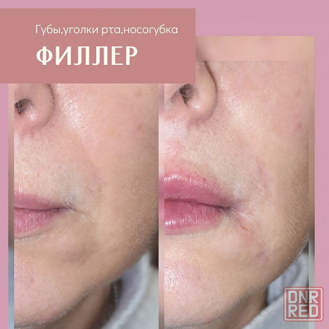Косметолог Запорожье. Увеличение губ, мезотерапия, татуаж Запорожье - изображение 3
